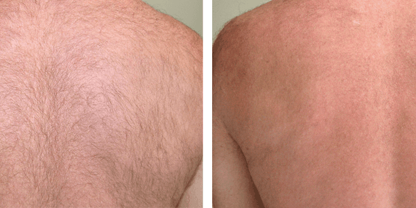 A before and after picture of a man 's back with hair.
