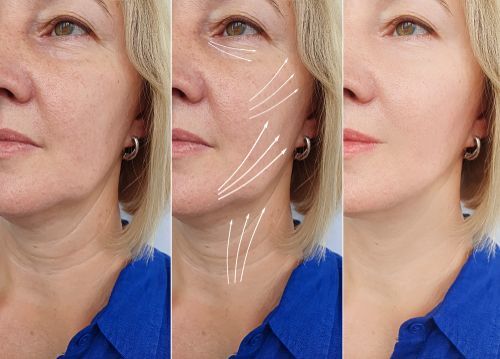 A before and after photo of a woman 's face with lines drawn on it.