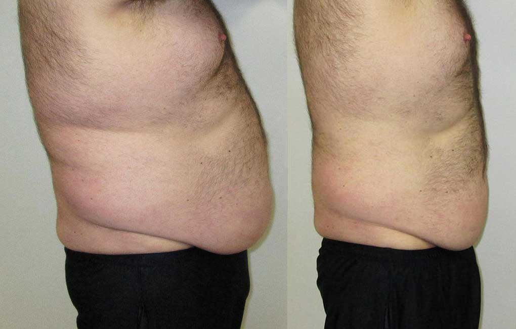 A man 's stomach is shown before and after losing weight.