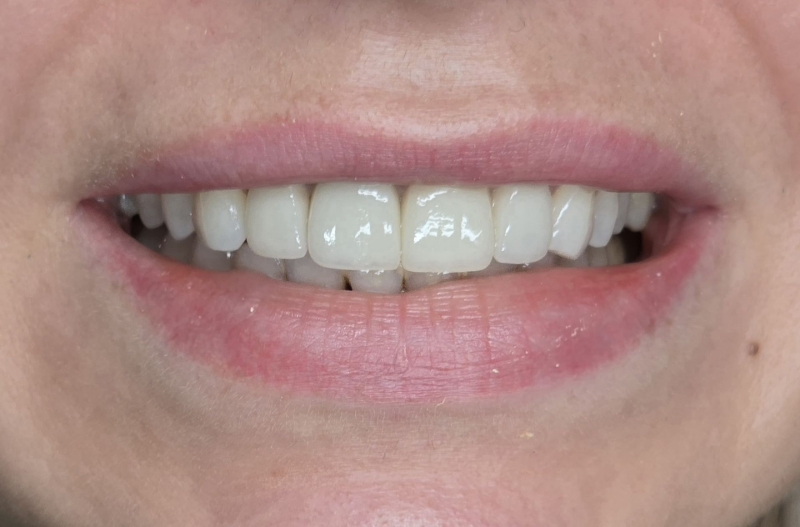 Close-up of a smiling mouth with visible teeth and pink lips