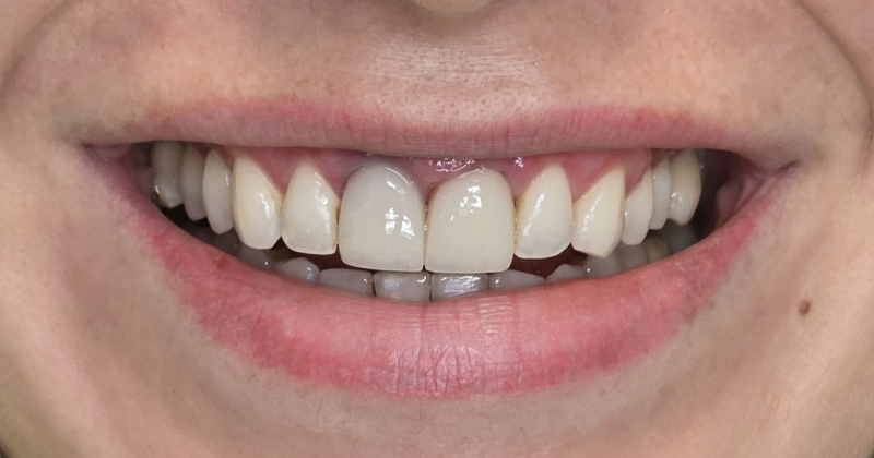 Close-up of a smiling mouth showing white teeth with one front tooth slightly misaligned
