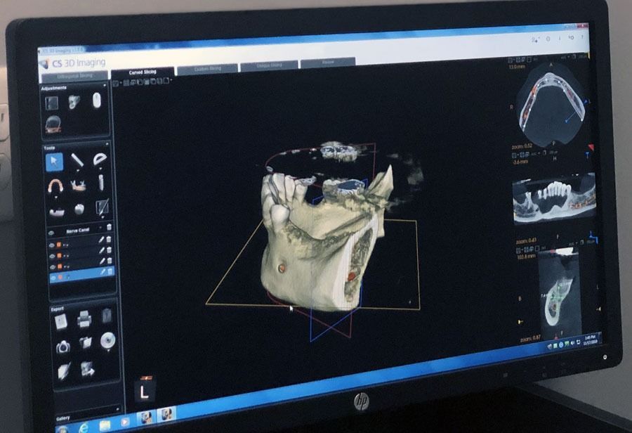 Dental 3D scan displayed on a monitor, showing a white jaw model in dark software interface