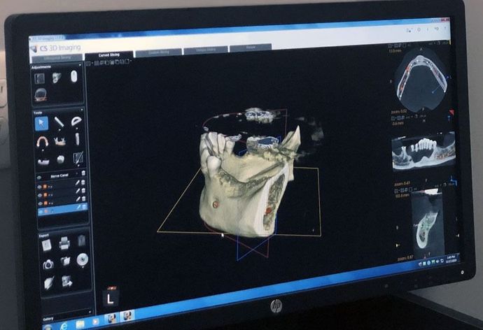 Computer monitor displaying a 3D dental scan on medical imaging software
