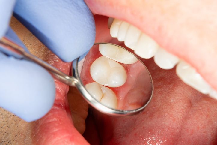 Dentist examining teeth with a dental mirror and gloved hand