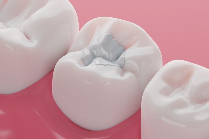 Close-up of white molars with a silver filling on pink gums