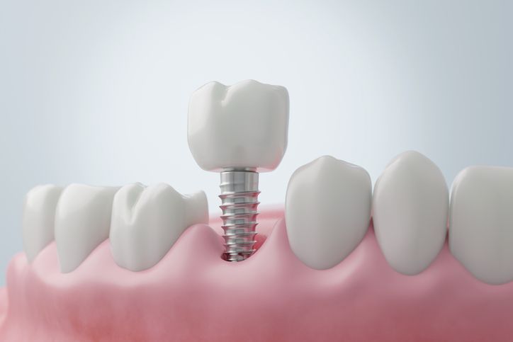 Dental implant in pink gum with adjacent teeth and a white crown on top.