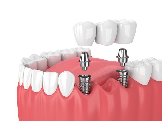 3D dental implant illustration with two implants in a pink gum and teeth above