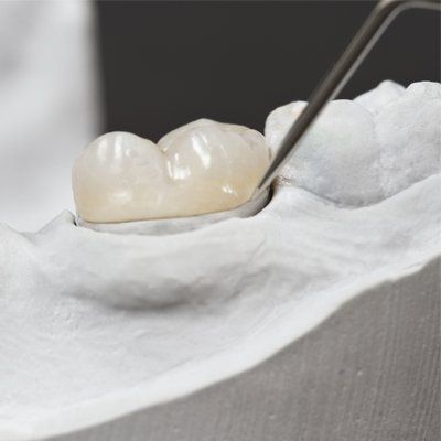 Tooth Bonding — Crowns in Modesto, CA