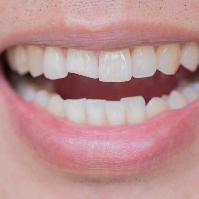 Cosmetic Dentistry — Damaged Teeth in Modesto, CA
