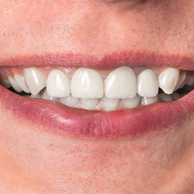 Tooth Bonding & Chip Repair — Perfectly Repaired Teeth in Modesto, CA