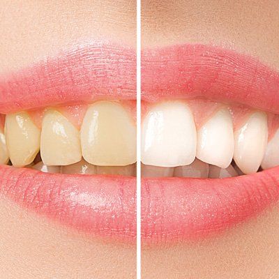 Teeth Bleaching — Before and After in Modesto, CA