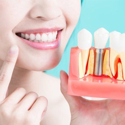 Dental Implants — Complete White Teeth in Modesto, CA