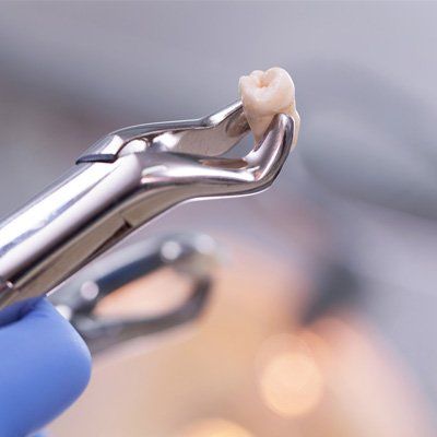 Wisdom Teeth — Tooth Extraction in Modesto, CA