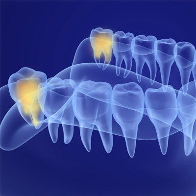 Wisdom Teeth Issues — Digital Wisdom Teeth Examination in Modesto, CA