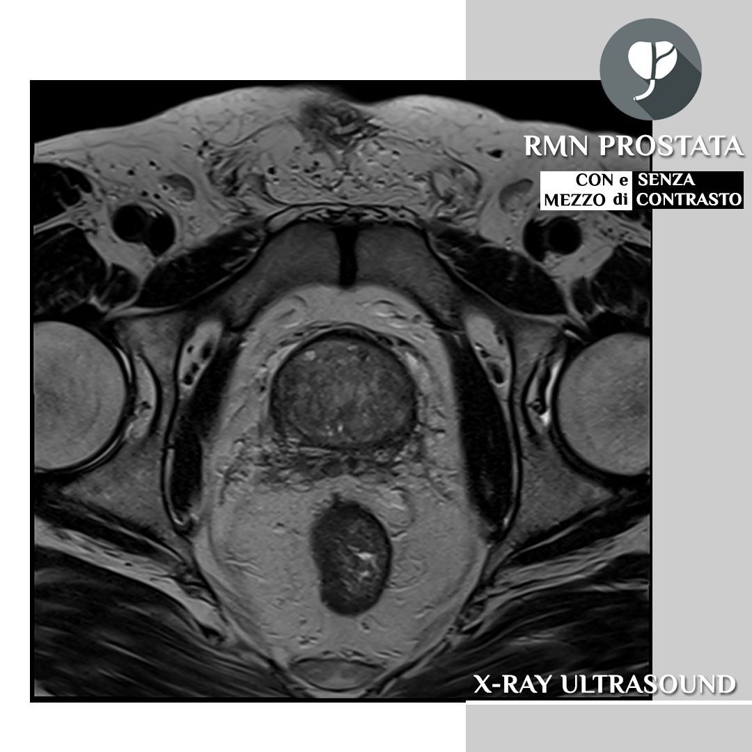 RMN prostata