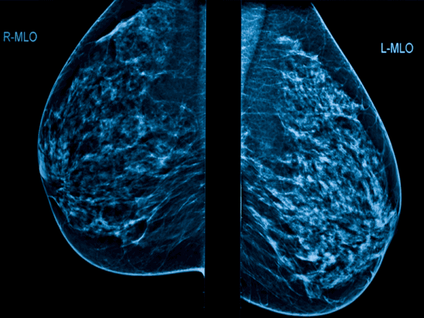 radiografia mammografica moc