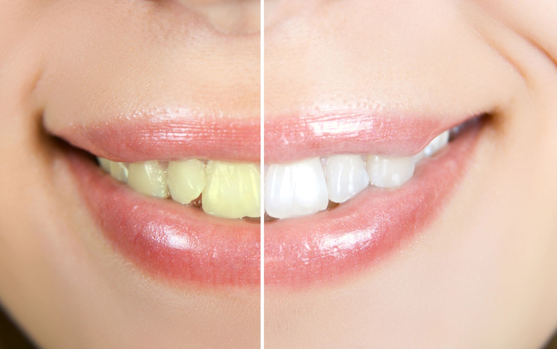 Un primo piano di un sorriso che mostra il contrasto tra i denti ingialliti a sinistra e quelli sbiancati a destra, prima e dopo.