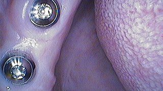 Nahaufnahme des Mundes mit zwei sichtbaren metallischen Zahnimplantaten, umgeben von rosa Zahnfleisch.