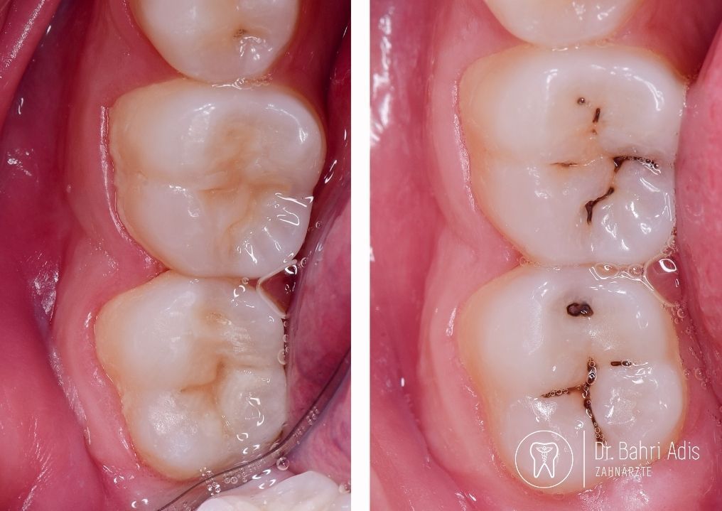 Two dental views of molars showing cavities and restored teeth.