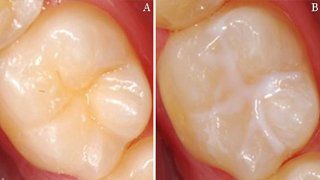 Zwei Nahaufnahmen von Zähnen, eine mit einem leichten Gelbstich (A) und die andere mit weißen Glanzlichtern (B).