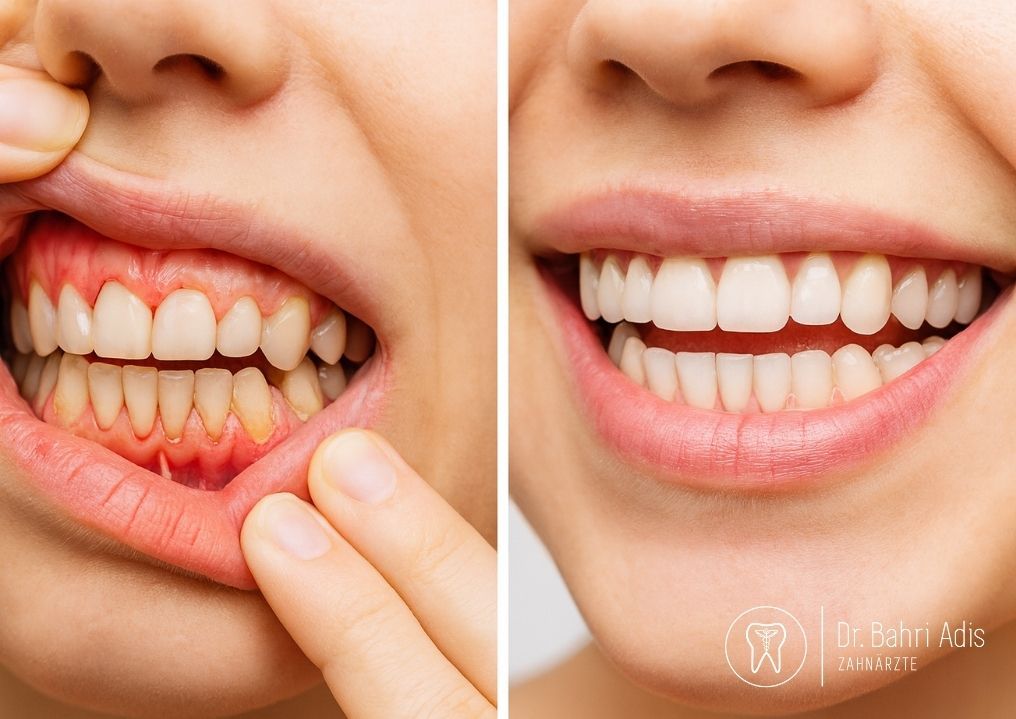 Vorher-Nachher-Fotos: Person mit ungesundem Zahnfleisch und ungesunden Zähnen, dann ein gesundes, weißes Lächeln.