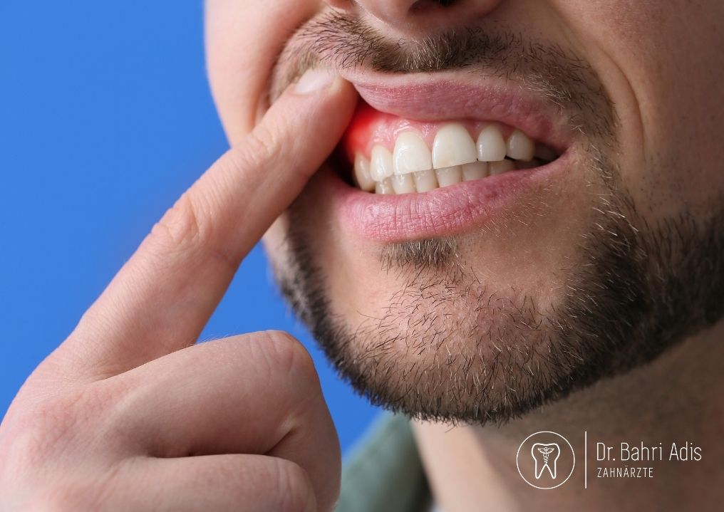 Zahnfleischbehandlung in Zürich – sanfte Parodontologie bei Sanitas Dental Care