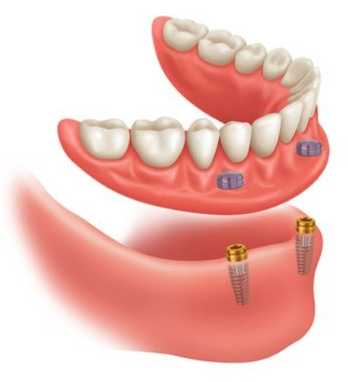 An illustration in Gresham, OR, of how dentures work

