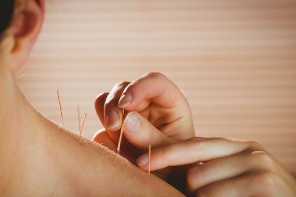 physiotherapist doing acupuncture on a woman's shoulder