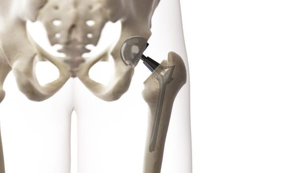 anatomy of hip replacement