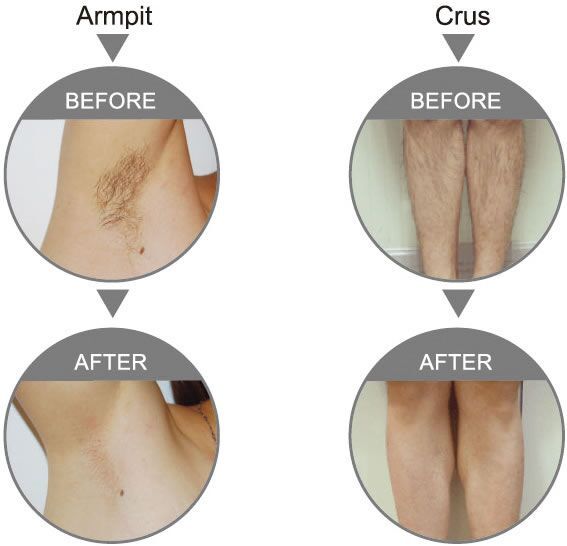 Super hair removal before and afters