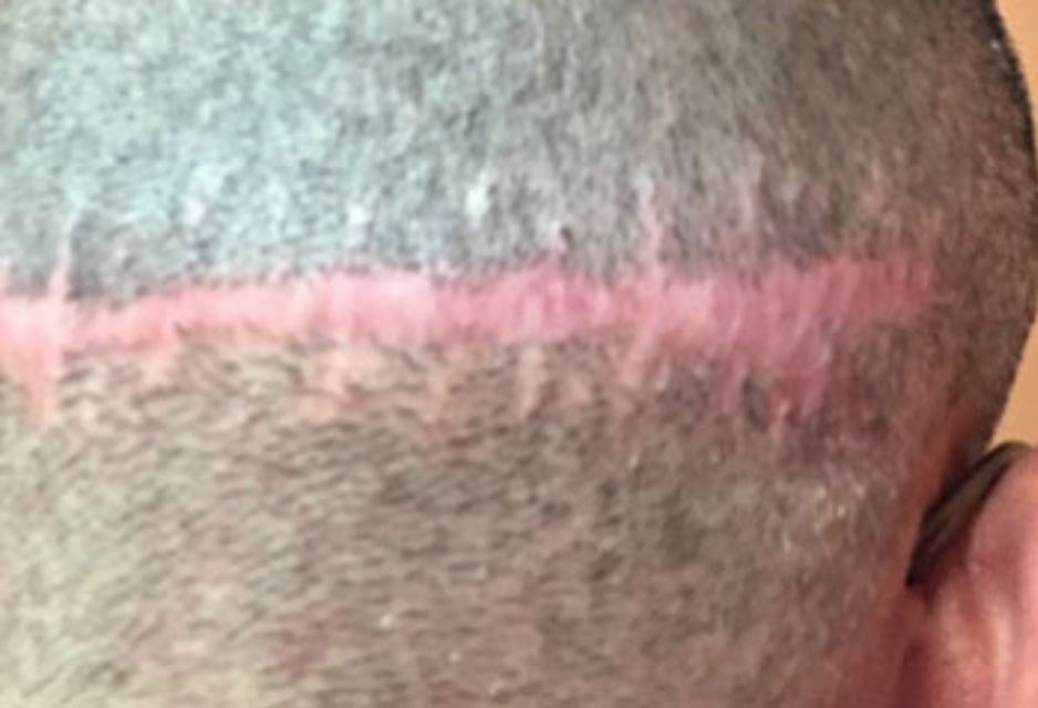 A close up of a person 's head with a scar on it.