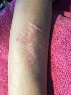 A person 's arm with a scar on it is laying on a pink towel.