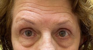 A close up of a woman 's face with wrinkles on her forehead.