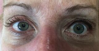 A close up of a woman 's eyes with a red nose.