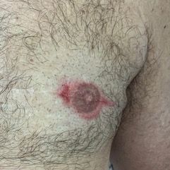 A close up of a man 's chest with a red spot on it.