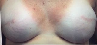 Areola restoration