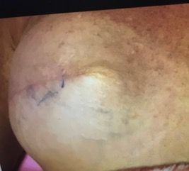 A close up of a person 's face with a stitch on it.