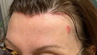 A close up of a woman 's forehead with a red spot on it.