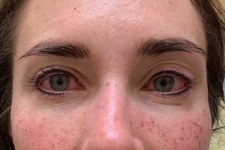 A close up of a woman 's face with red eyes and freckles.