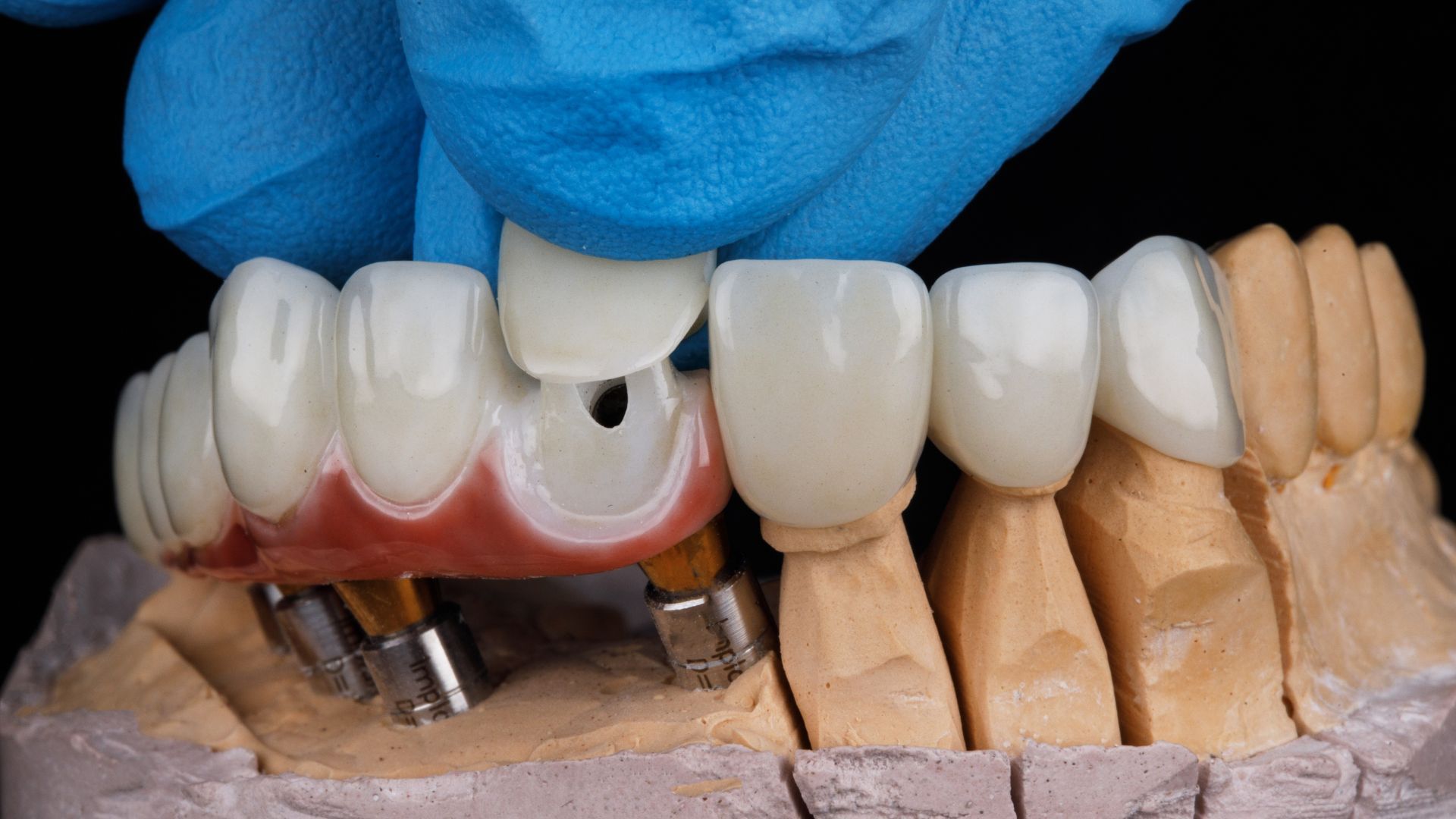 a person wearing blue gloves is working on a model of teeth