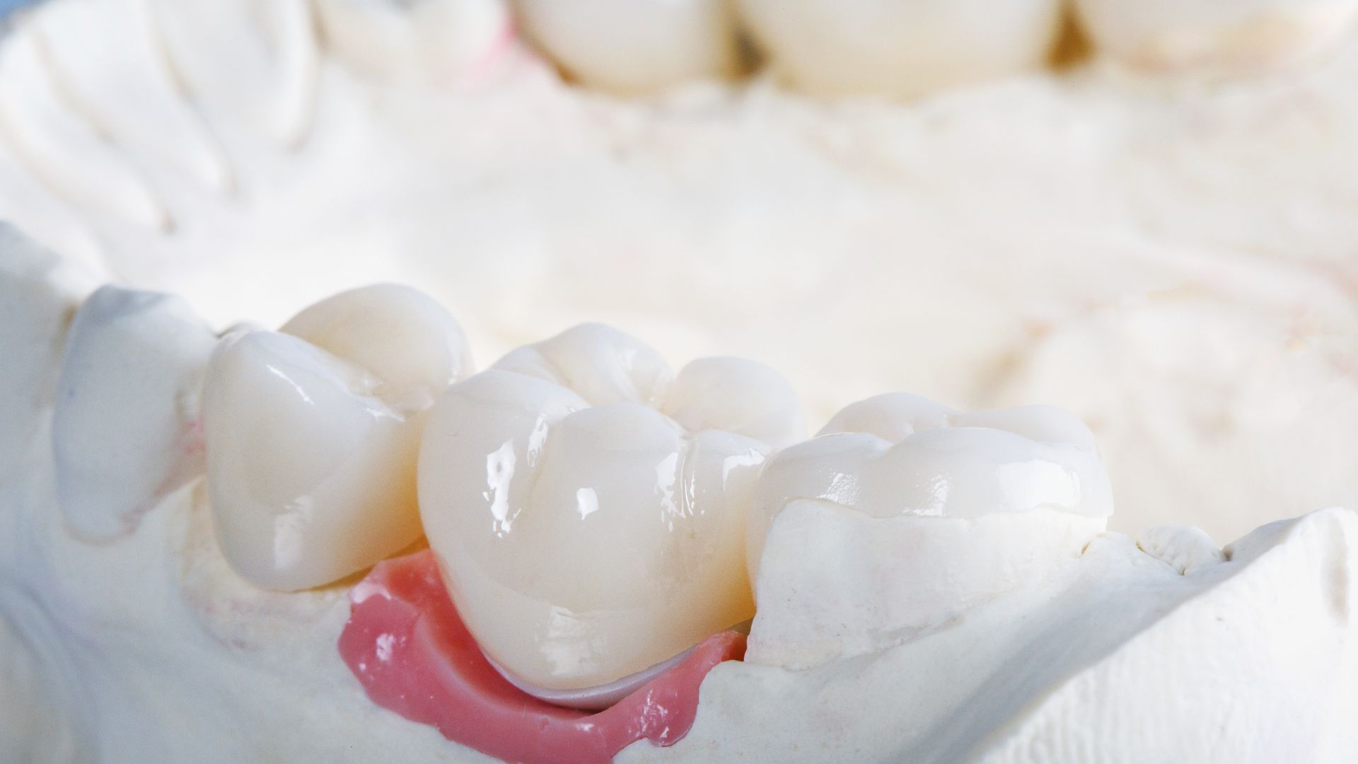 a close up of a model of a tooth with a crown on it