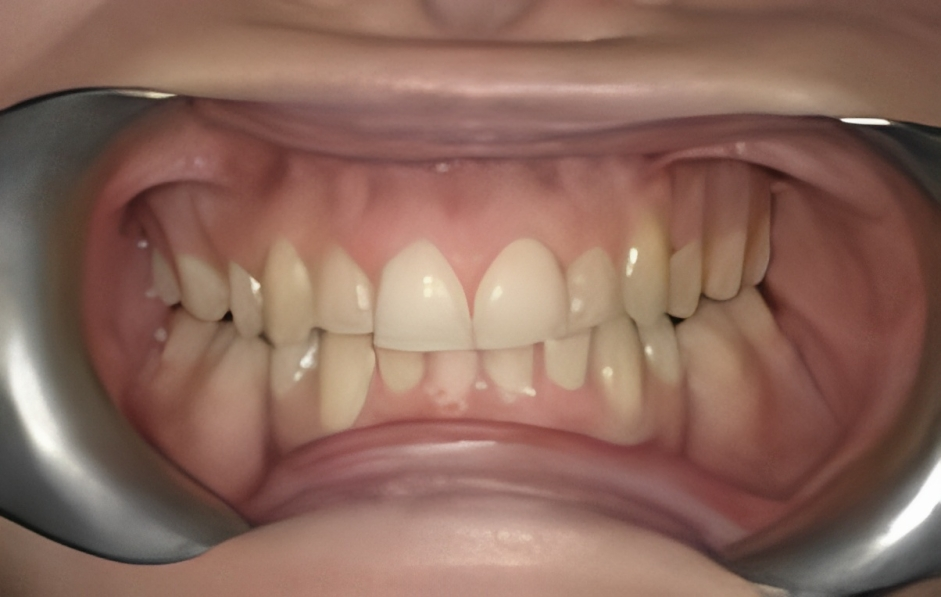 teeth alignment clip