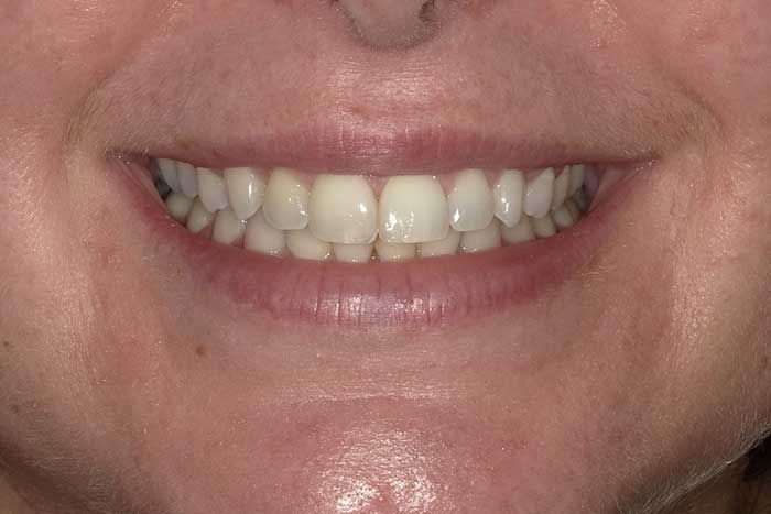 teeth alignment
