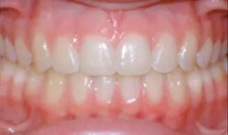 after alignment of teeth