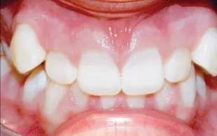 before alignment of teeth