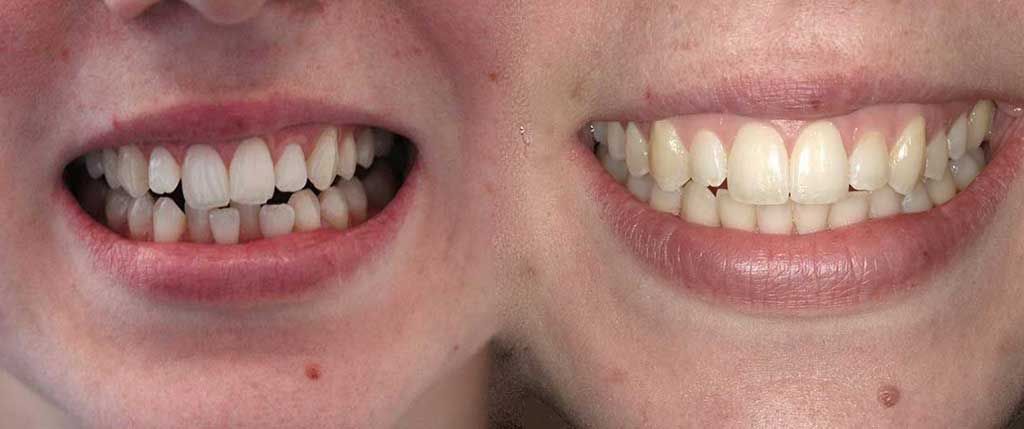 proper teeth alignment