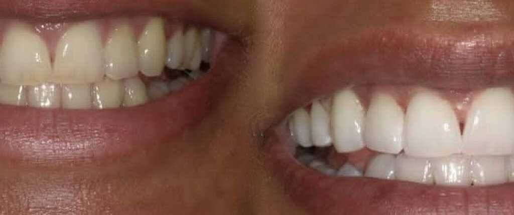 overlapping teeth