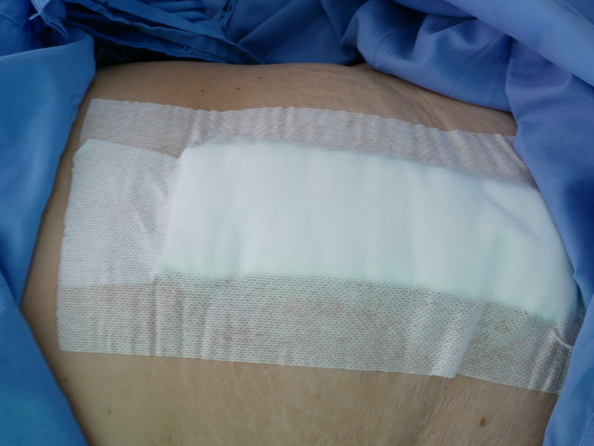A sterile surgical dressing with a white absorbent pad and adhesive borders secured over skin on a person's abdomen.