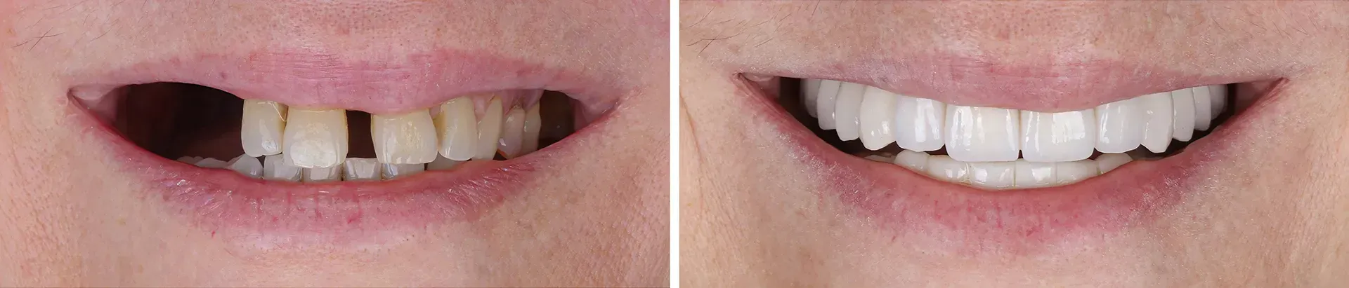 A before and after photo of a woman 's teeth.