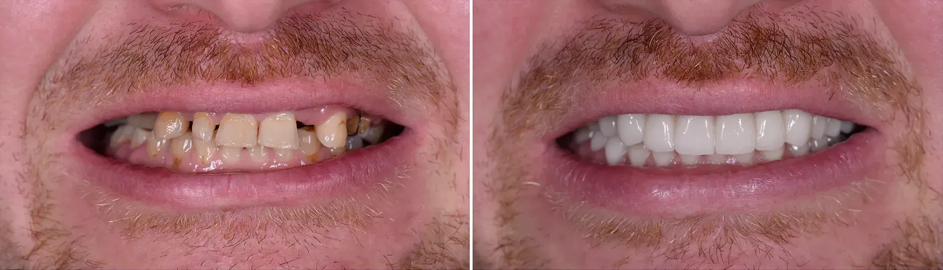 A before and after picture of a man 's teeth.